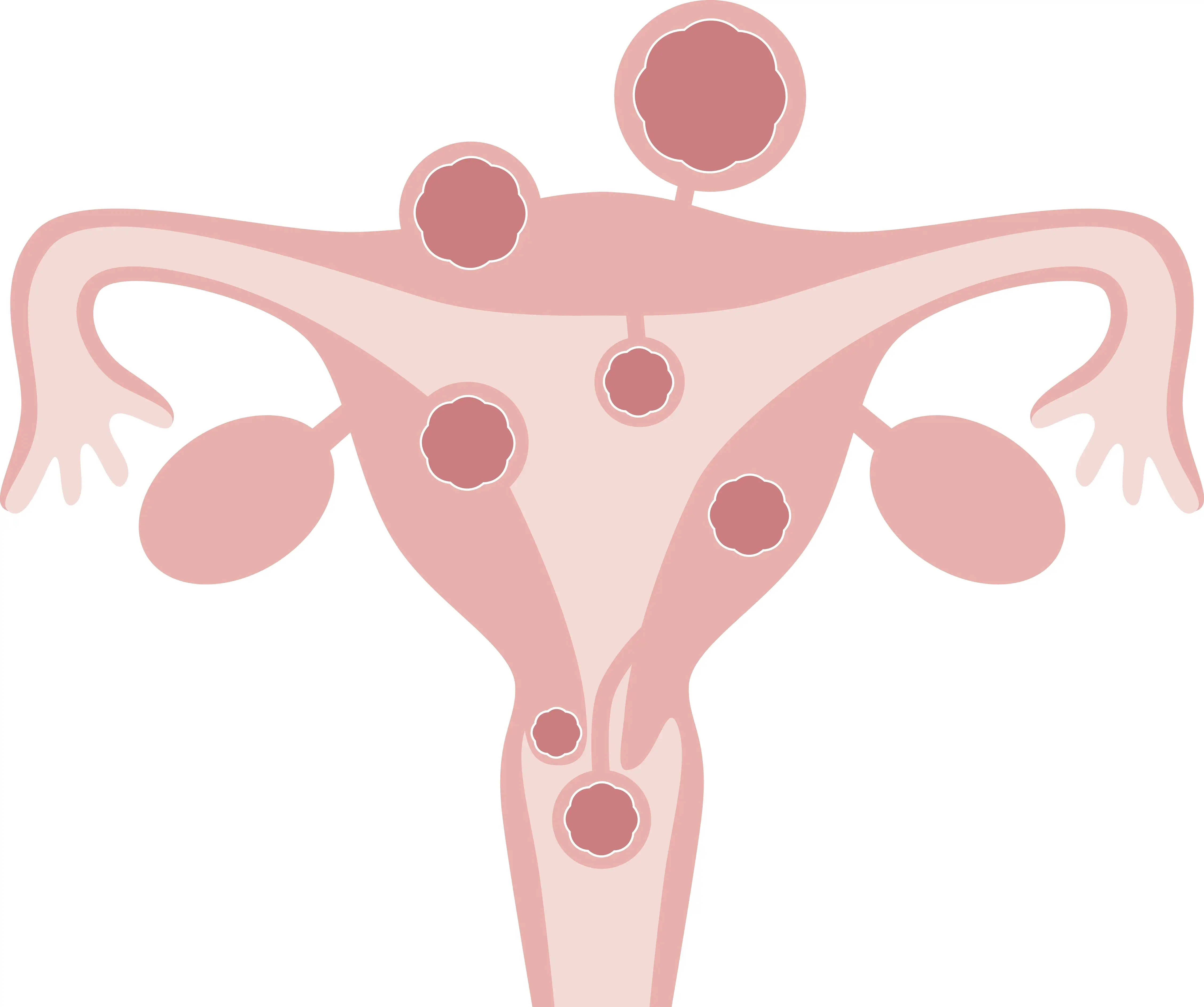 Polycystic ovarian syndrome