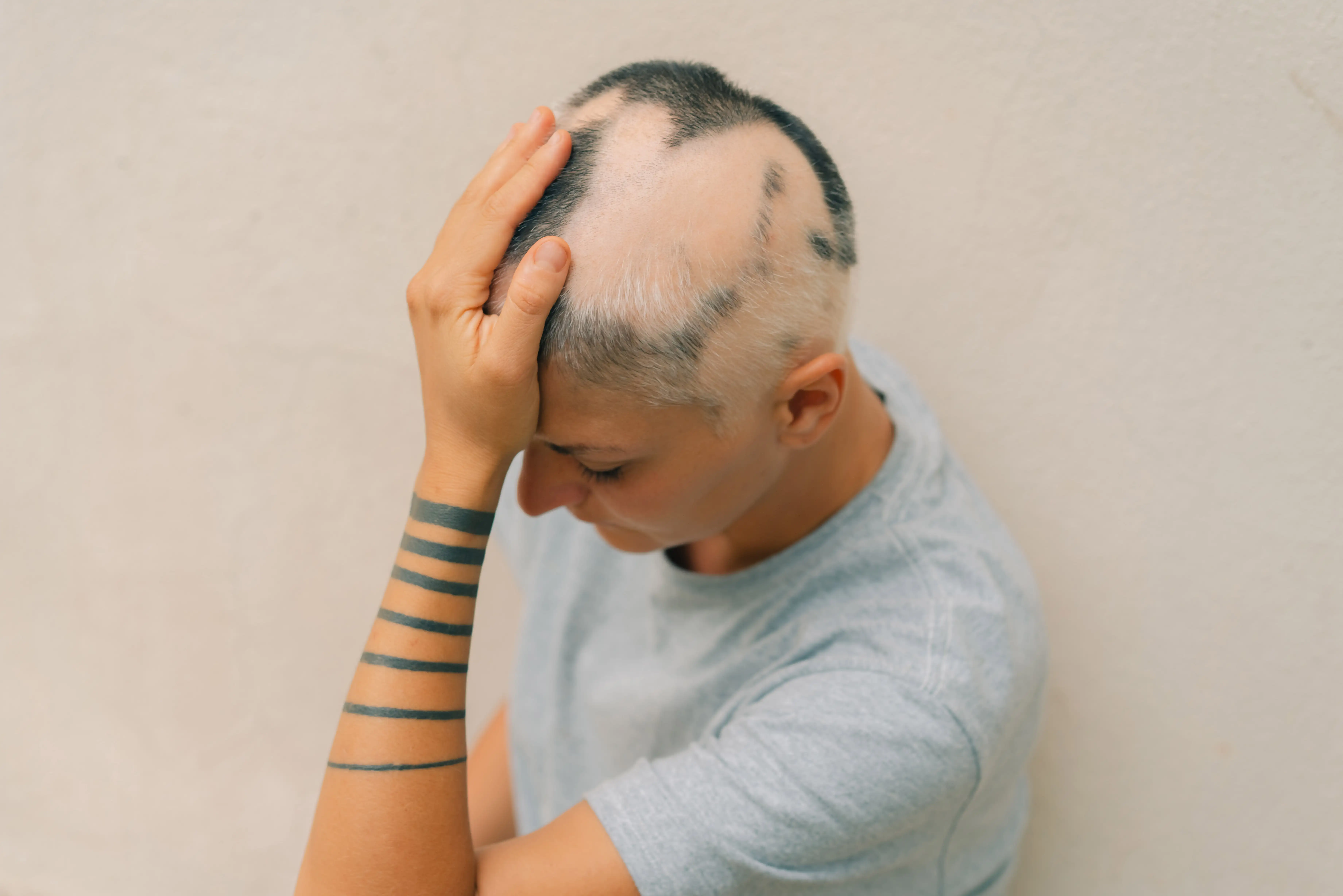 Androgenetic alopecia