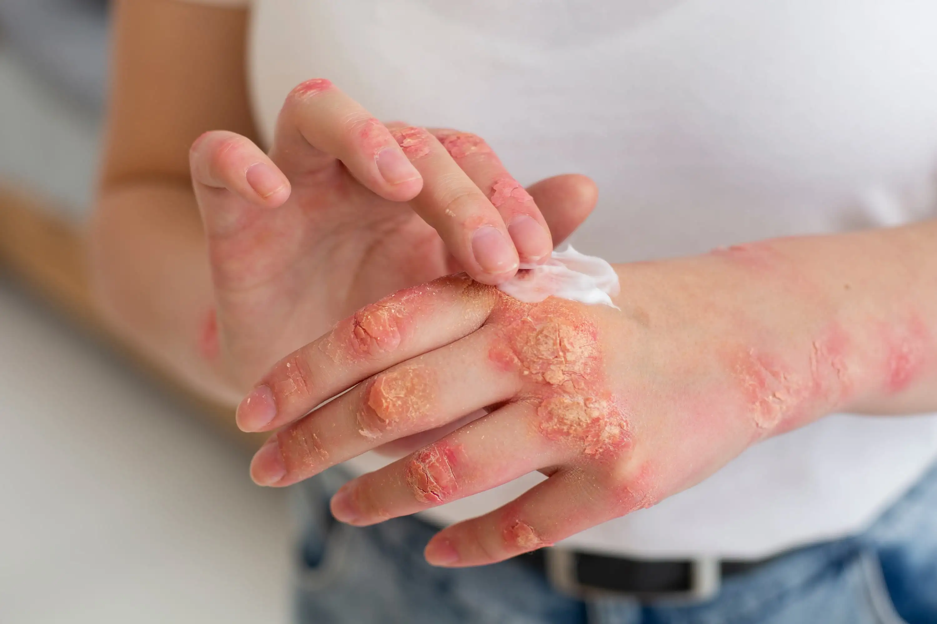 Hand eczema