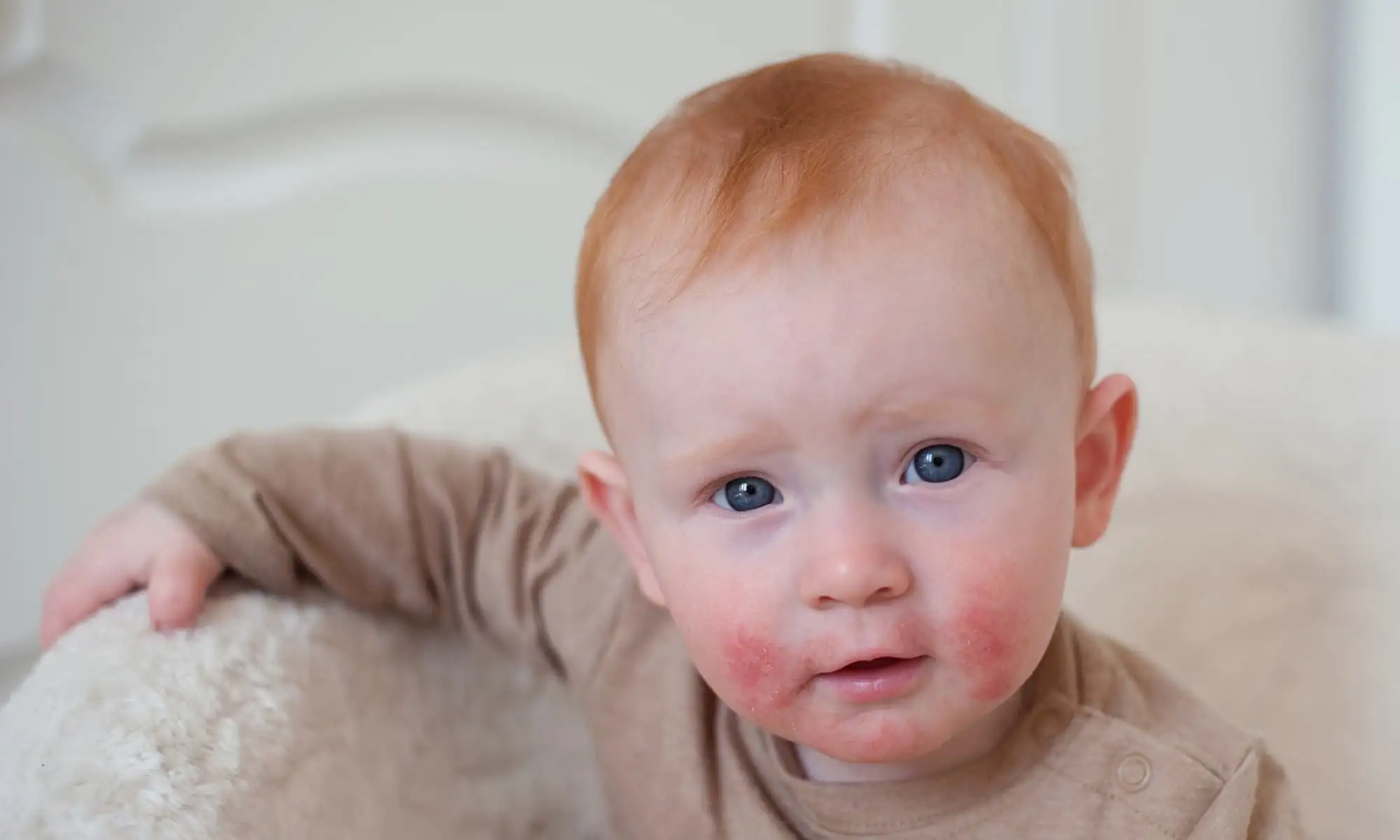 Atopic dermatitis in children