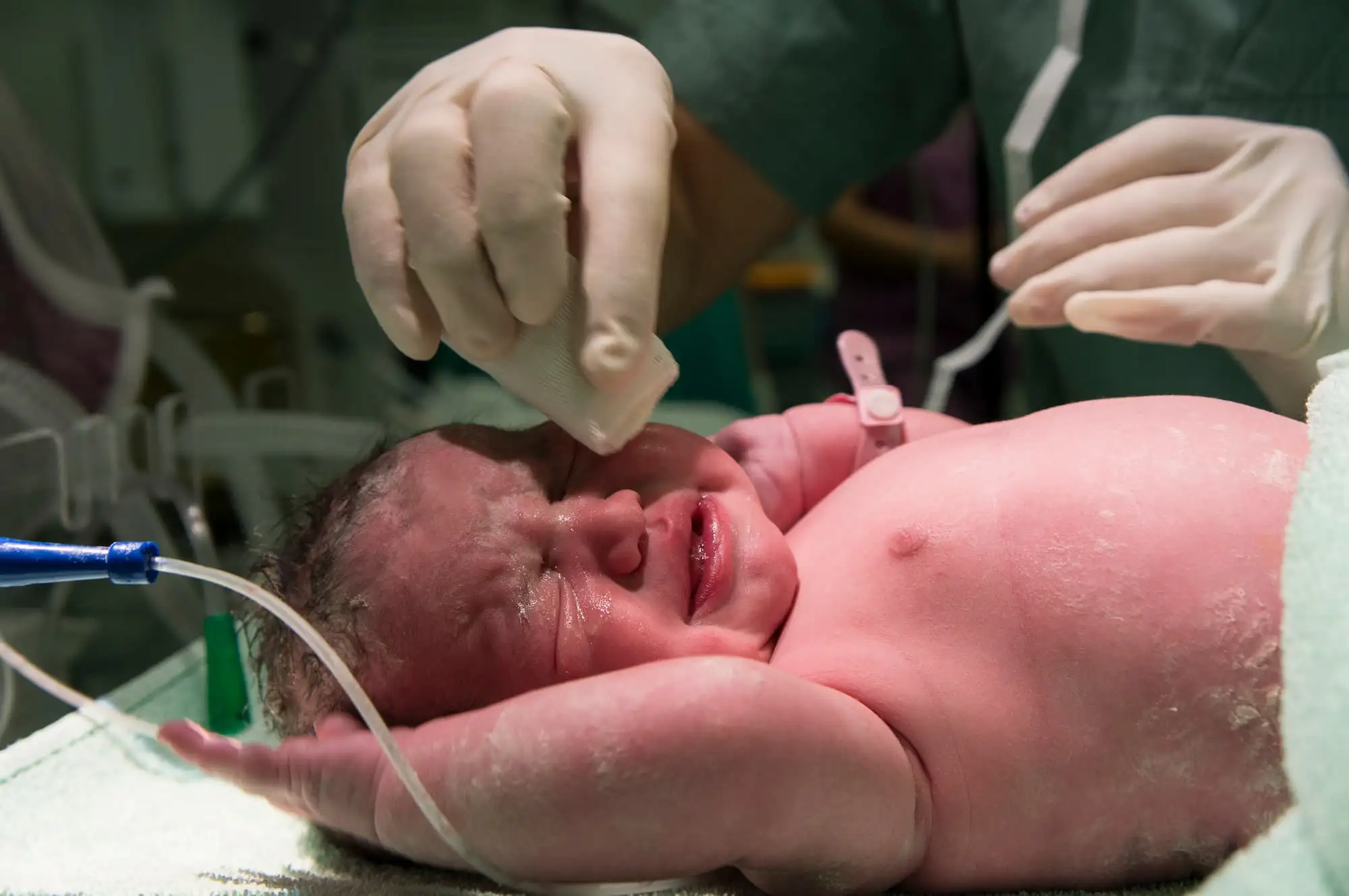 Survival of preterm infants