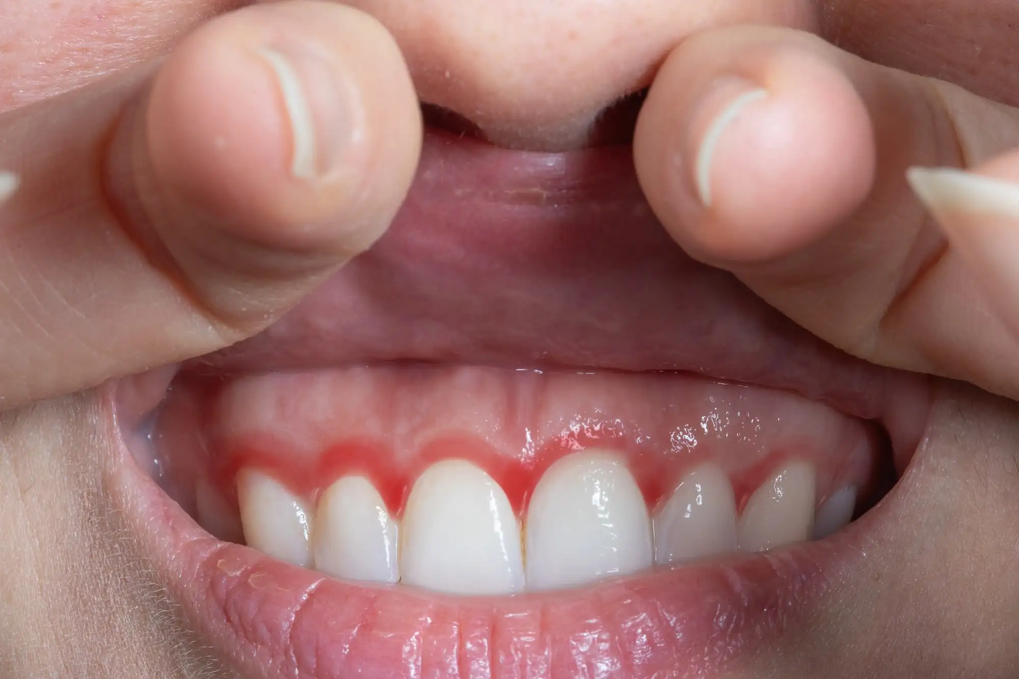 Periodontitis