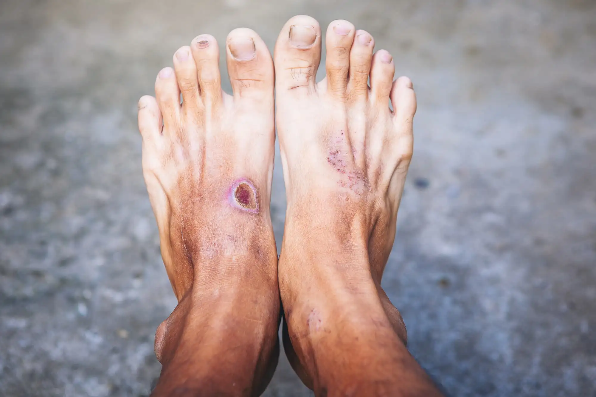 Diabetic foot ulcers