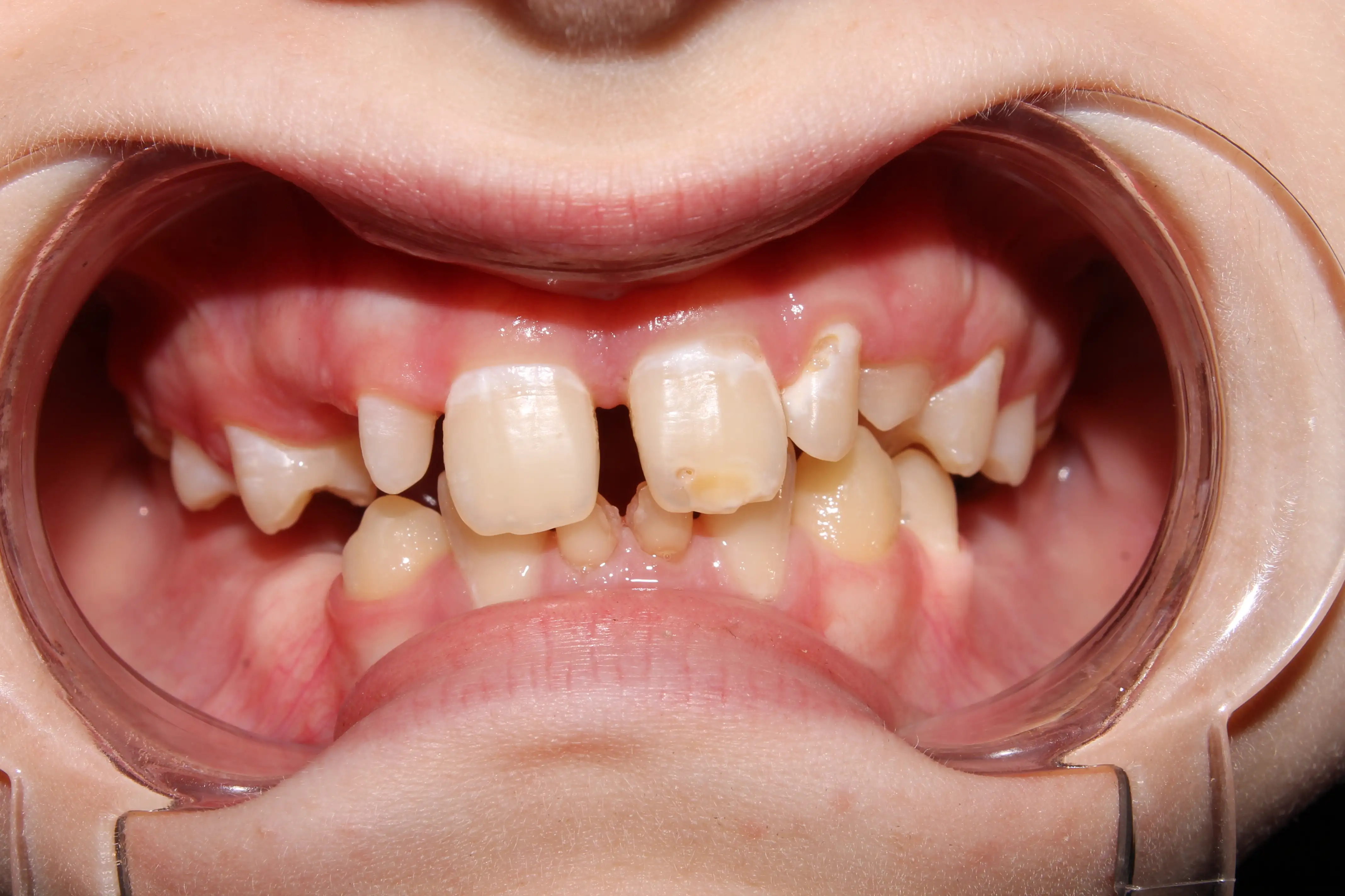 Type 2 diabetes, Periodontitis