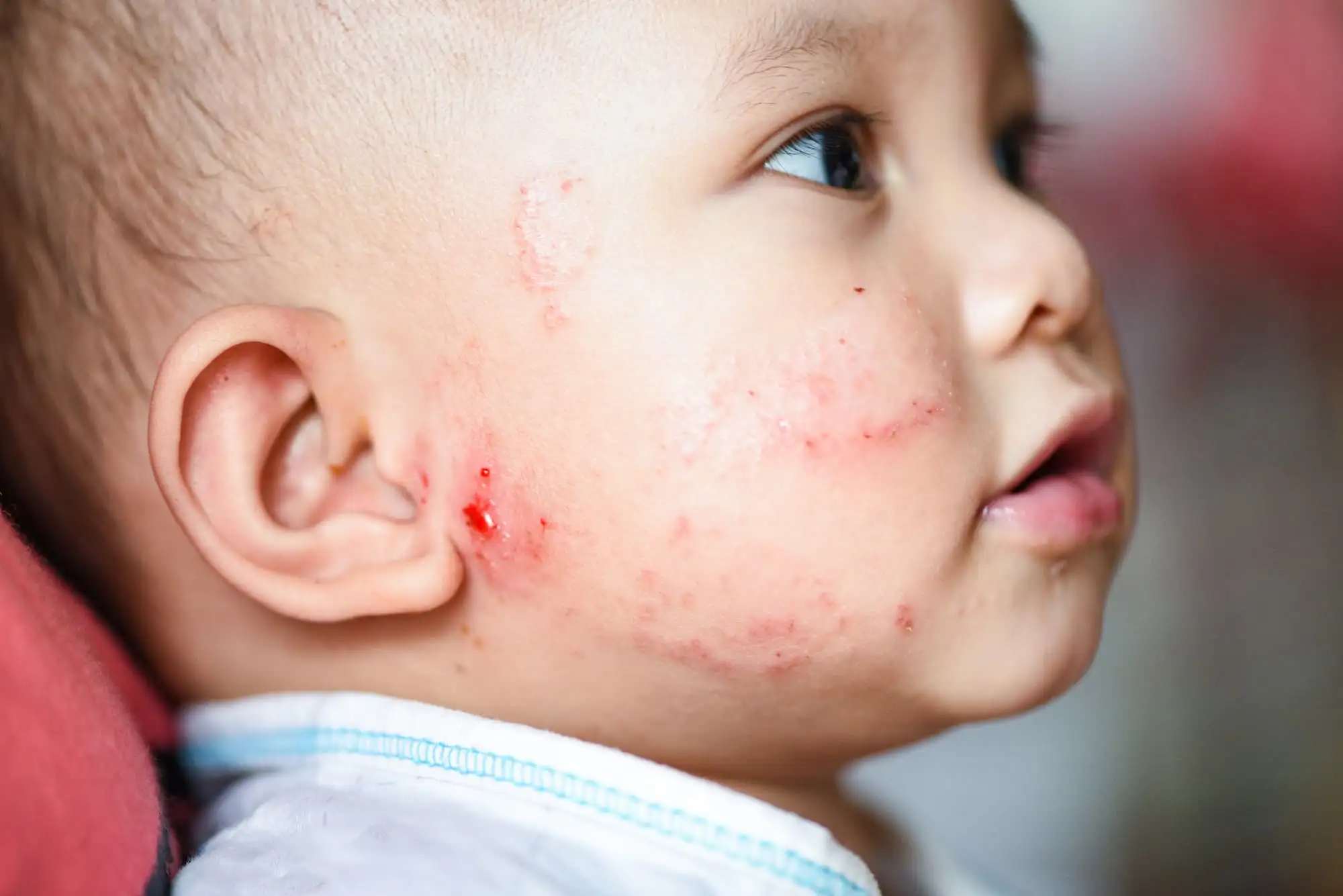 Atopic dermatitis