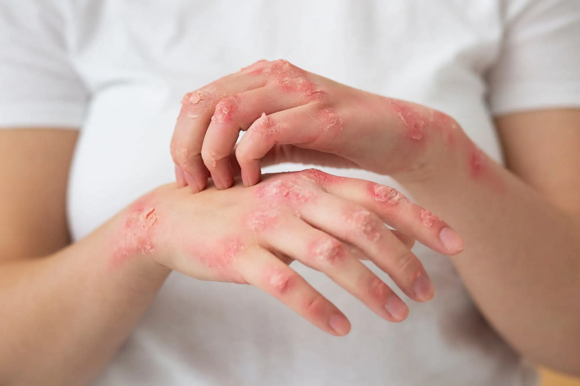 Atopic dermatitis