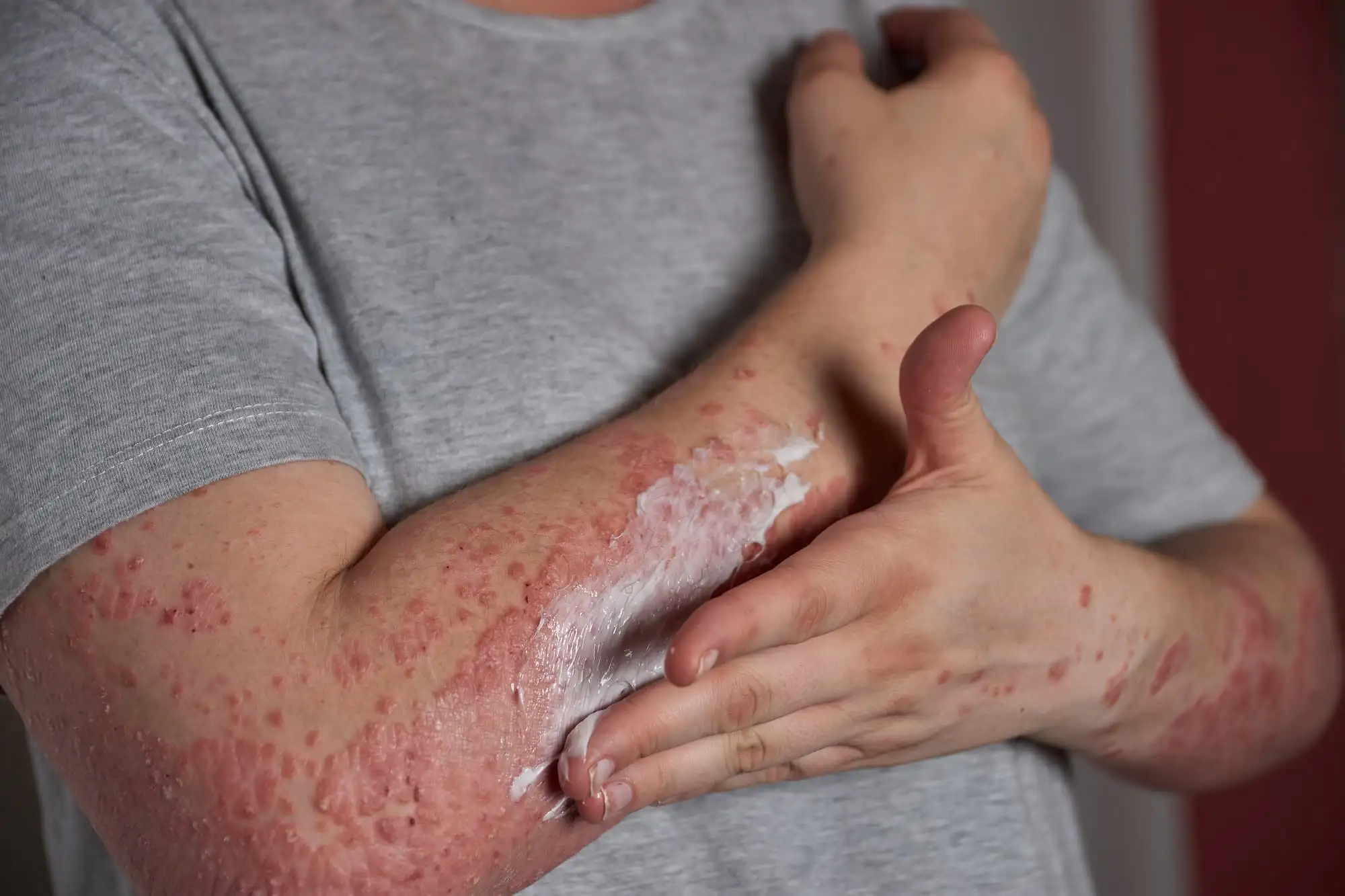Psoriasis vulgaris