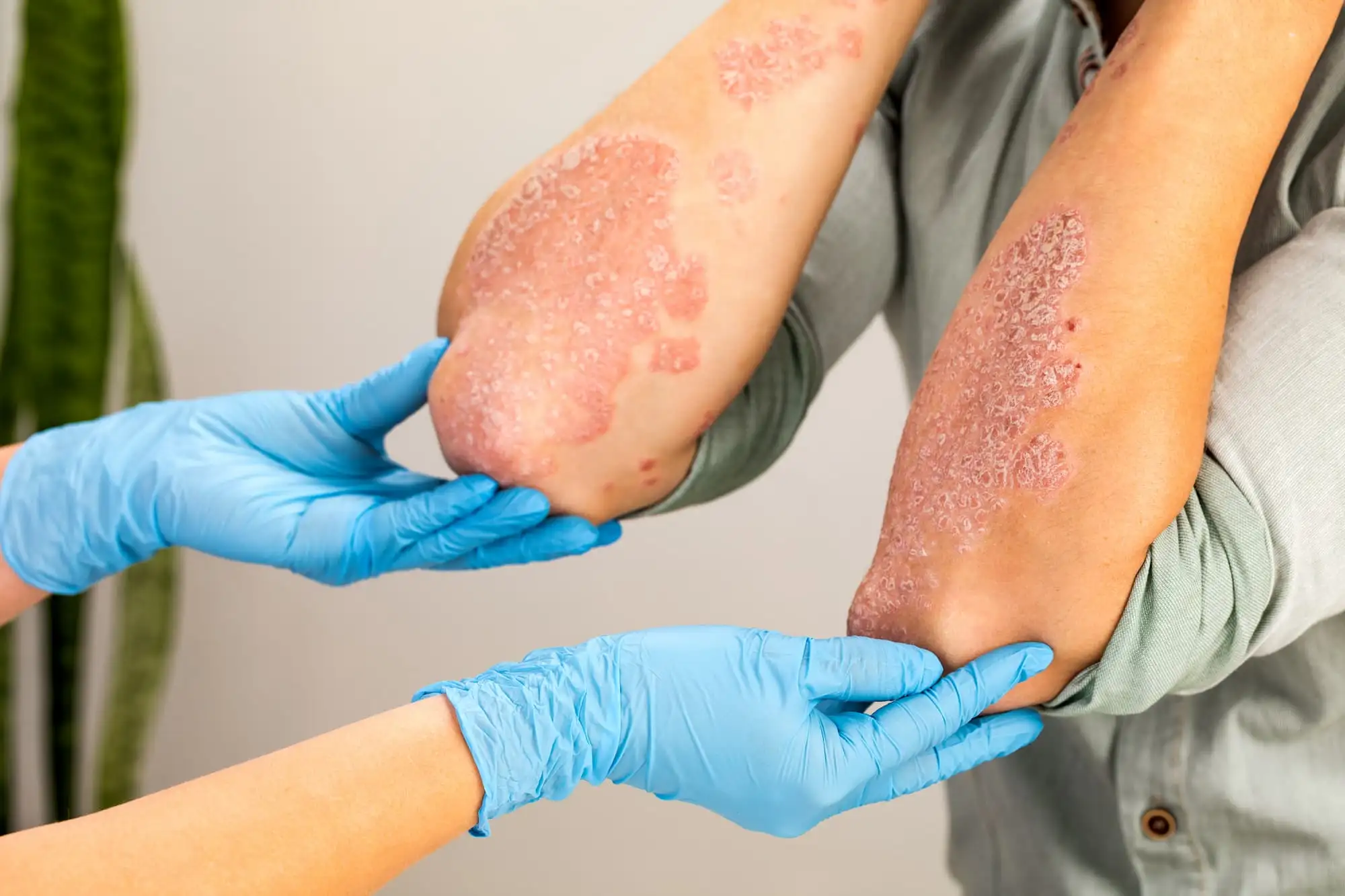 Plaque psoriasis