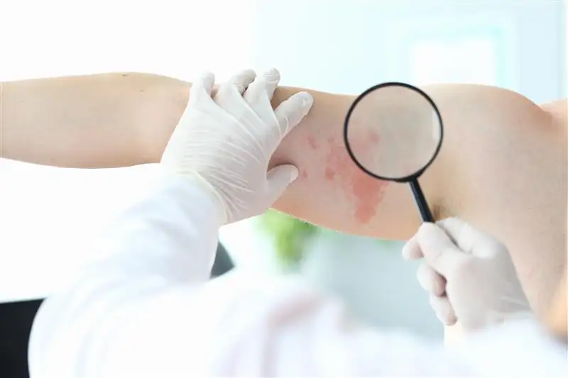 Chronic idiopathic urticaria