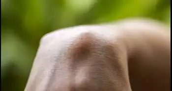 Оцінка болючого зап'ястно-п'ясткового виступу за допомогою магнітно-резонансної томографії