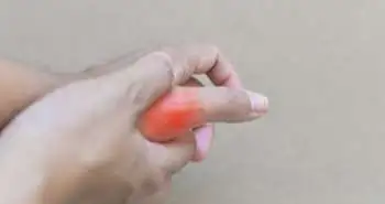 Закрита репозиція з черезшкірною фіксацією: безпечний метод лікування внутрішньосуглобового перелому основи першої п'ястної кістки