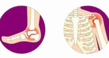 A study evaluated 2 years outcomes in recent-onset monoarthritis patients