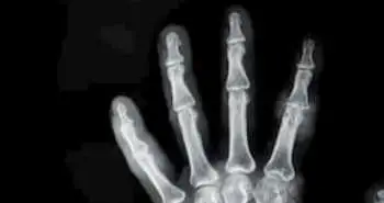 Порівняння застосування ферумоксітолу та гадолінію як контрастної речовини при магнітно-резонансній діагностиці остеомієліту