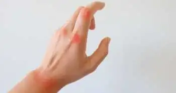 Довгострокова безпека застосування адалімумабу: розвиток інфекцій, відповідь на вакцинацію та наслідки вагітності в пацієнток із ревматоїдним артритом