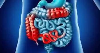 Препарат 5-ASA має лікувальний потенціал при хворобі Крона