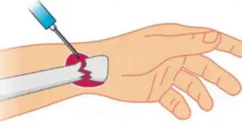 Гематомна блокада є безпечною анальгезією при закритих дистальних переломах променевої кістки