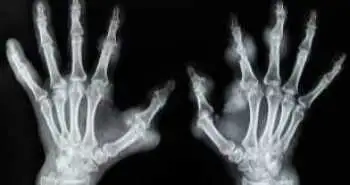 Як виявилося, комбінація метотрексату з rhTNFR:Fc може ефективно запобігати ураженню структури хряща при РА