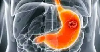 Рекомендації «ICON-G» проти НПЗП-гастропатії