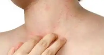 Алергологія: назальна гіперактивність