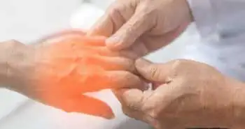 Дослідили ефективність капсаїцинового пластиря в лікуванні периферичного невропатичного болю