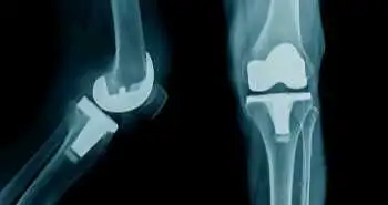 Оксфордська шкала оцінки функції колінних суглобів як незалежний прогностичний фактор досягнення максимального післяопераційного результату після тотального ендопротезування колінного суглоба