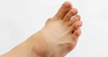 Застосування дапагліфлозину в поєднанні з верінурадом і фебуксостатом - важливе доповнення до терапії подагри