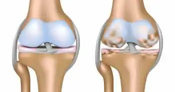 Метод безперервної ультразвукової терапії в комбінації з диклофенаком сприяє зниженню вираженості симптомів остеоартрозу колінного суглоба