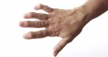 Таргетна терапія першої лінії у пацієнтів з РА може бути більш ефективною, ніж традиційний підхід