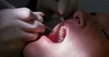 Профілактичне застосування німесуліду забезпечує клінічно значуще зниження інтенсивності болю після хірургічного втручання на третьому молярі