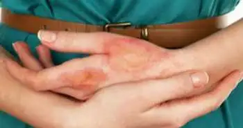 Показана висока ефективність іксекізумаба у пацієнтів з псоріатичним артритом