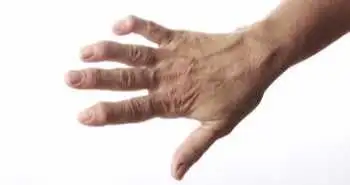 Досліджено прихильність до лікування тофацитинібом пацієнтів з ревматоїдним артритом