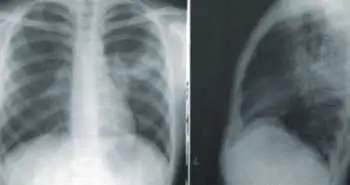 Лекція «Механізм формування запалення та болю»