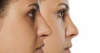 Періоперативне використання сульфату магнію ефективно зменшує кровотечу при ринопластиці