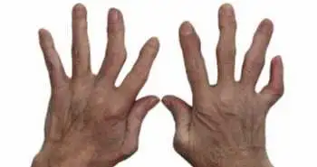 Застосування баріцітініба при ревматоїдному артриті не супроводжується підвищеним ризиком розвитку інфекцій