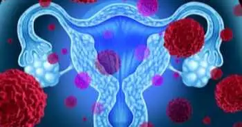 Довгострокове подальше спостереження за результатами оперативного втручання з приводу ендометріозу: в деяких випадках може знадобитися проведення повторного оперативного втручання