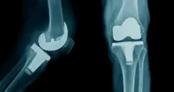 Ін'єкції спріферміна при остеоартрозі колінного суглоба визнані безпечними