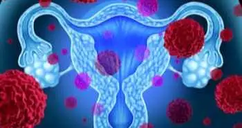 Тривала медикаментозна терапія знижує ризик рецидиву після лапароскопічного видалення ендометріом