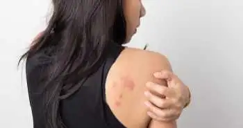 Ефективність антигістамінних препаратів у пацієнтів з хронічною спонтанною кропив'янкою, які отримують терапію омалізумабом