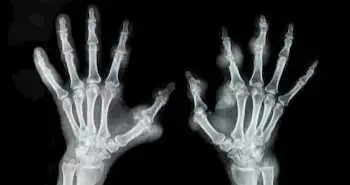 Використання ПЕТ / КТ з фторидом натрію F-18 для оцінки активності ревматоїдного артриту