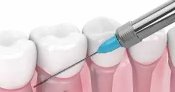 Доведено ефективність та безпечність модифікованої пародонтальної анестезії при лікуванні карієсу зубів
