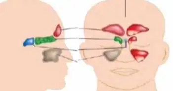 Симптоми синуситу