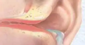 Симптоми отиту і тонзиліту