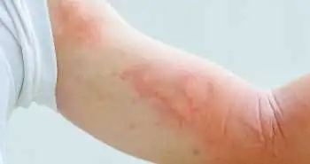 Зволожуючі креми та очищувальні засоби з церамідами сприяють покращенню стану шкіри, ураженої при екземі