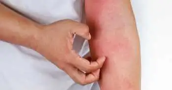 Безпека та ефективність застосування комбінації упадацитинібу та топічного кортикостероїду для місцевого застосування при атопічному дерматиті