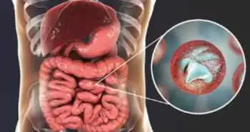 Ефект інтерферону гамма при COVID-19 у пацієнтів із паразитарними інфекціями