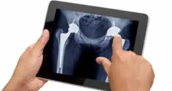 Ін'єкція карбоксимальтози заліза перед тотальною артропластикою кульшового суглоба знижує необхідність переливання еритроцитів.