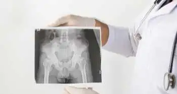 Оцінка ризику проведення тотального ендопротезування тазостегнового суглоба / тотального ендопротезування колінного суглоба, пов'язаного з лікарською терапією при ПсА/АС