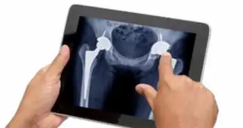 total_knee_arthroplasty