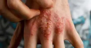 psoriasis