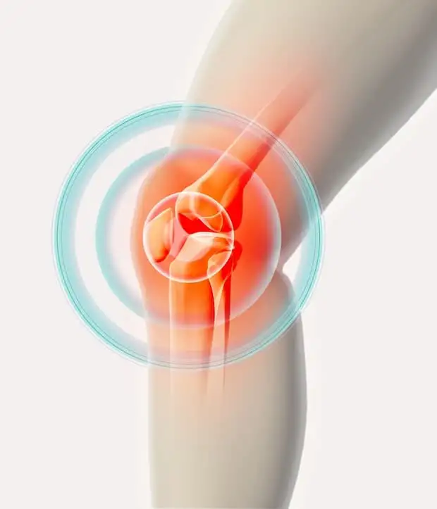 остеоартроз колінного суглоба